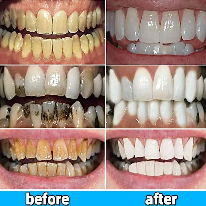 Dental Calculus Remover Whitening Removal Bad Breath Teeth Toothpaste Brightening Preventing Periodontitis Dental Cleansing Care - Cashdust