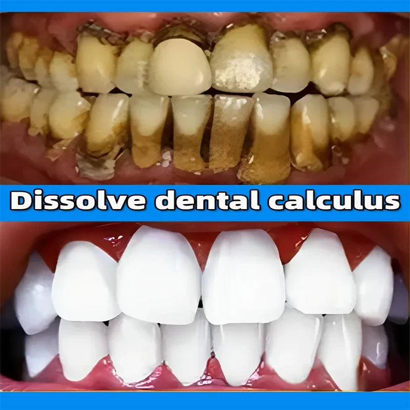 Dental Calculus Remover Whitening Removal Bad Breath Teeth Toothpaste Brightening Preventing Periodontitis Dental Cleansing Care - Cashdust